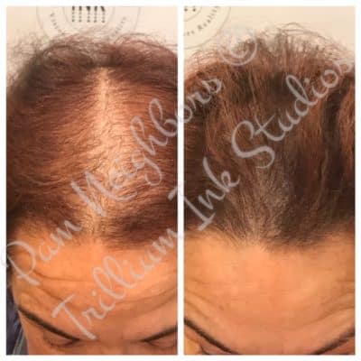 treatment for thinning older women