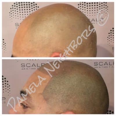 scalp micropigmentation on a man