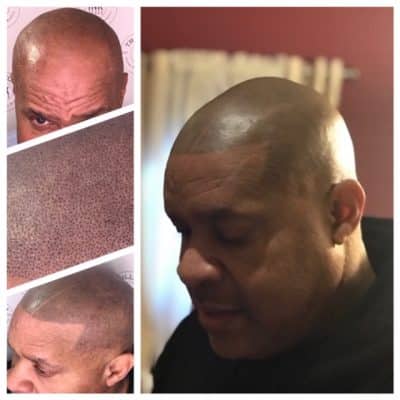 edge up hairline solution