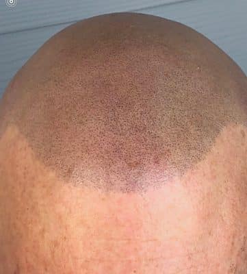 Trillium Ink Oregon scalp micropigmentation