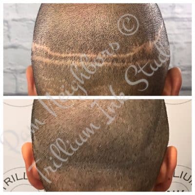 covering up a scar on the scalp