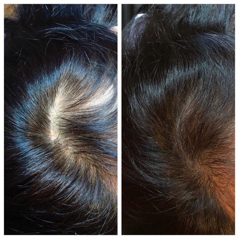 scalp micropigmentation