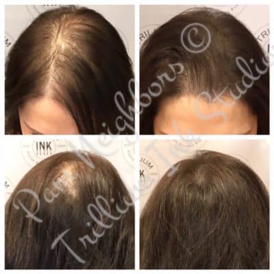 before and after smp for a woman
